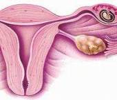 sarcina extrauterina