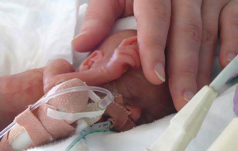 Cel mai mic copil din lume nascut prematur